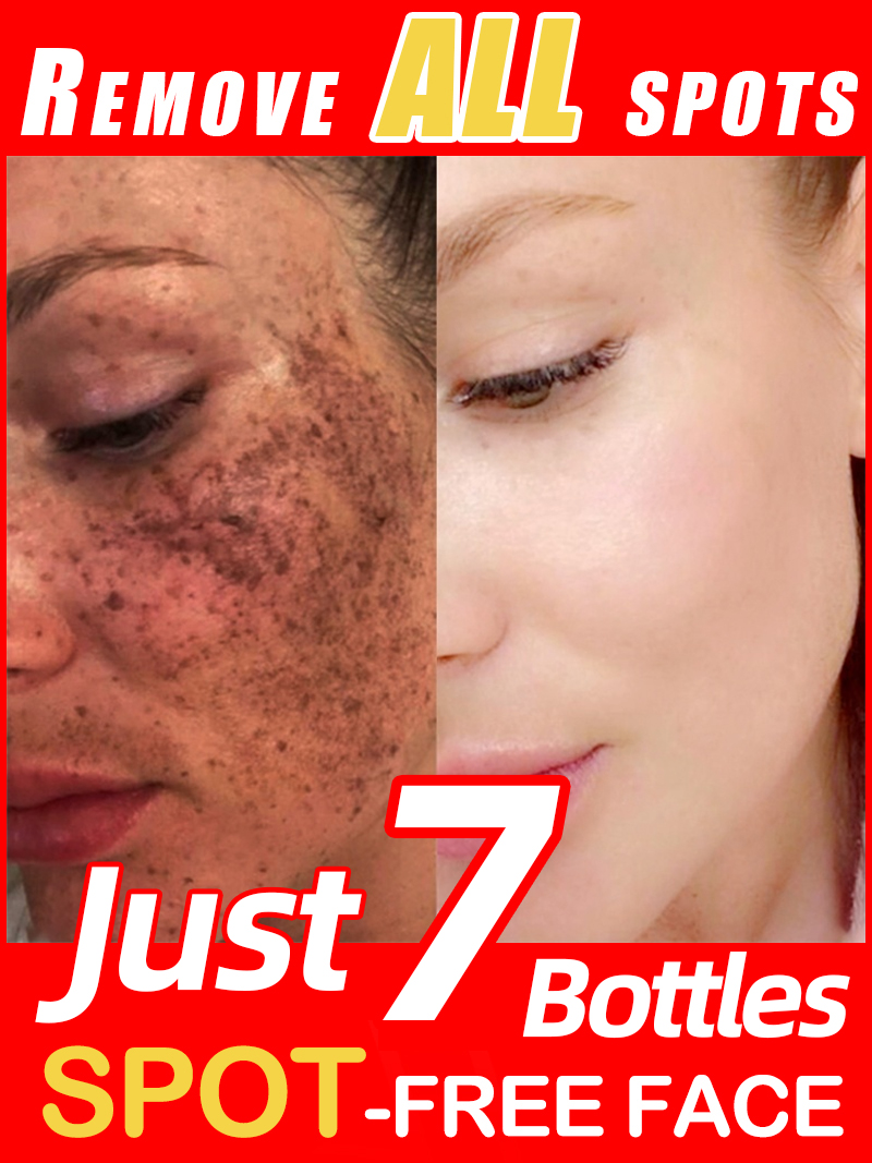 Lighten Freckles Melasma, Faci - огляд і ціна Ultra Luxury Skincare